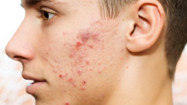 boy-with-acne-e1483632996311 (2020_01_06 18_35_16 UTC)